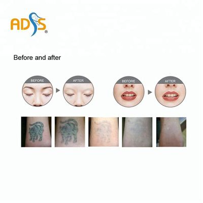 Laser à commutation de Q Pico Laser Tattoo Removal Machine 1064nm 532nm de ND Yag